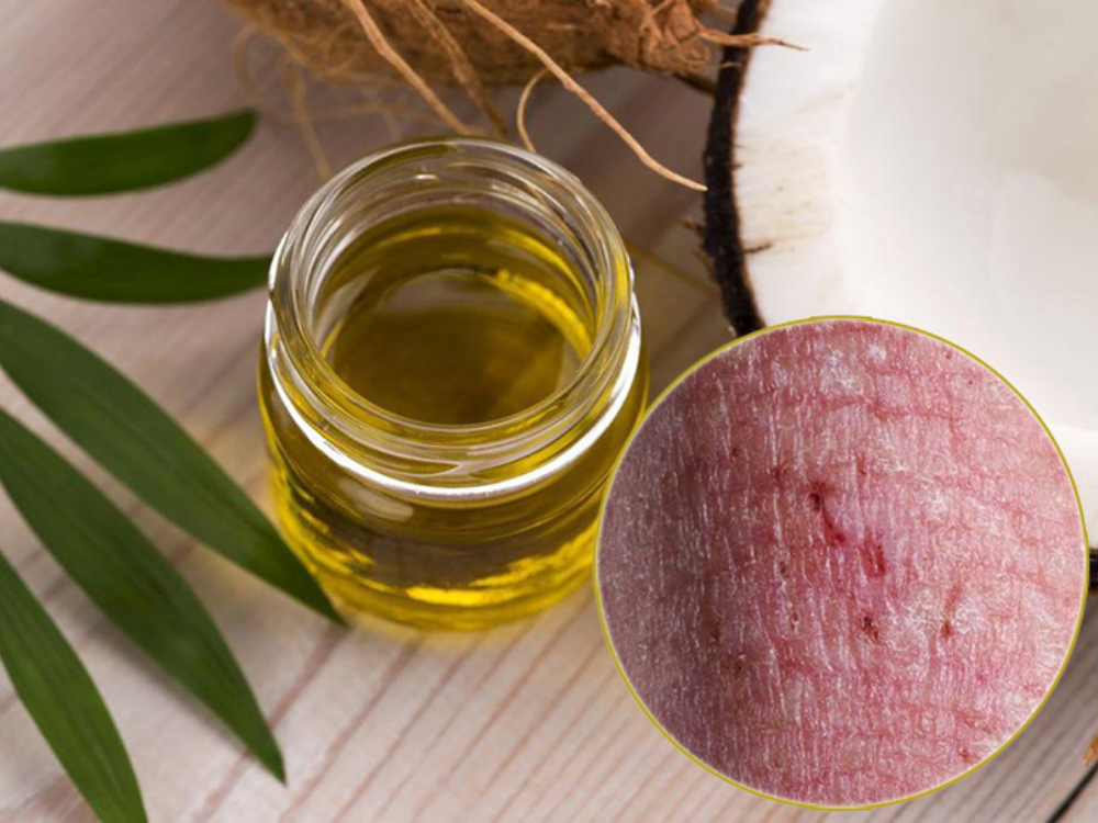Dầu dừa cùng những món ăn chiên ráng